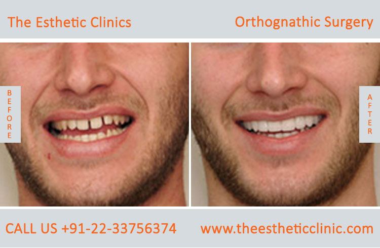 Orthognathic Surgery, Jaw Correction Surgery before after photos in mumbai india (10)
